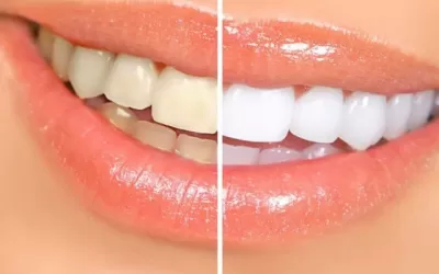 All Natural Teeth Whitening Tips!