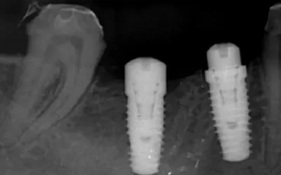 Question: What Are Dental Implants?